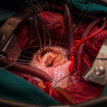 הלב במהלך ניתוח לב פתוח