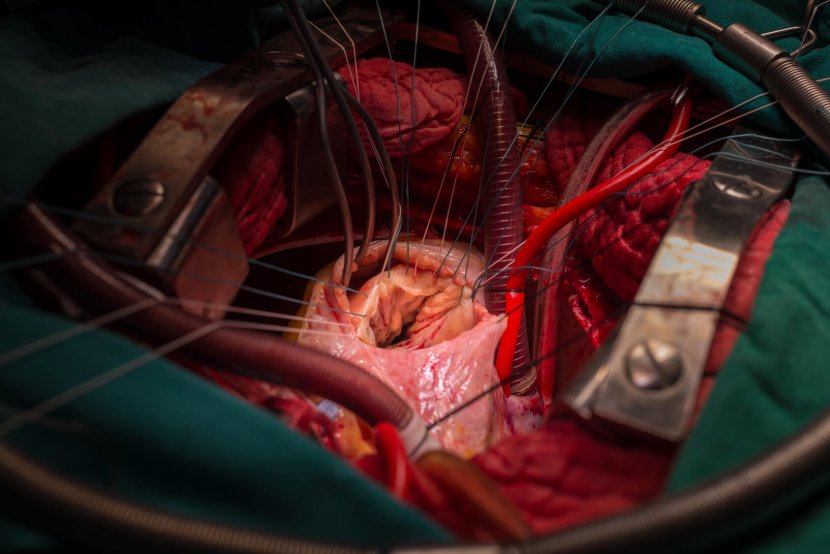 ניתוח מעקפי לב