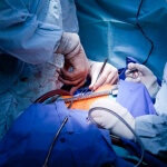 רופאים עוסקים בניתוח מעקפי לב